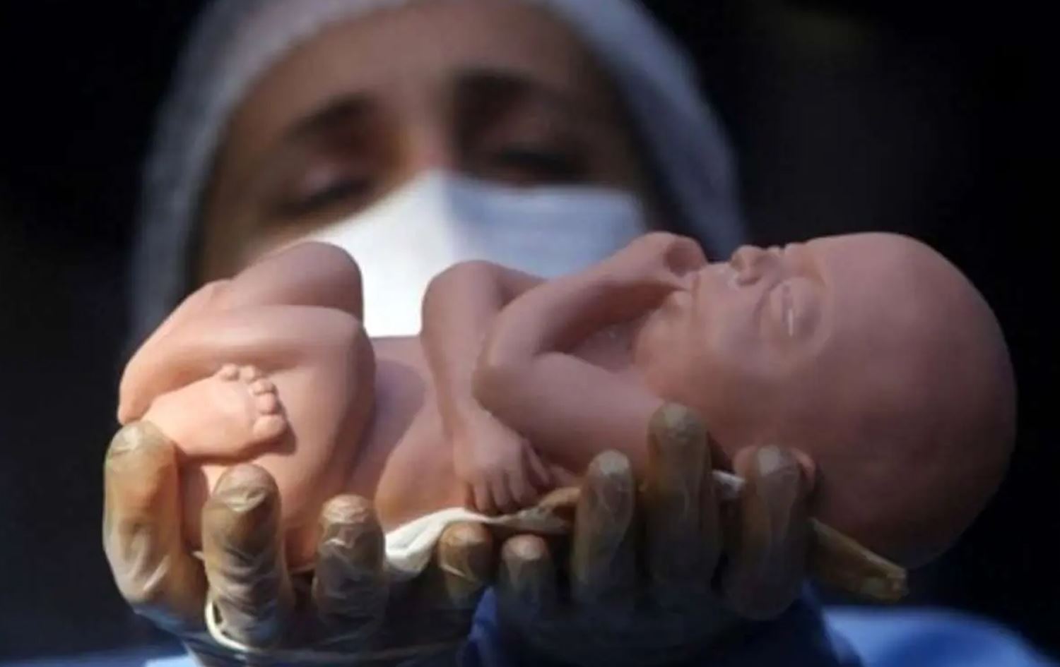 کۆرپەلەیەکی نموونەیی بەدەست کارمەندێکی تەندروستییەوەیە.