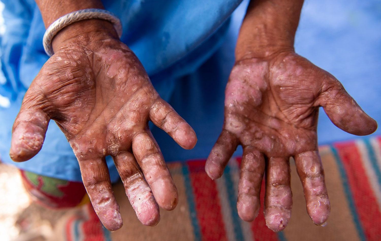 Destê kesekî ku bi nexweşiya kotîbûnê ye / Wêne: Arşîv