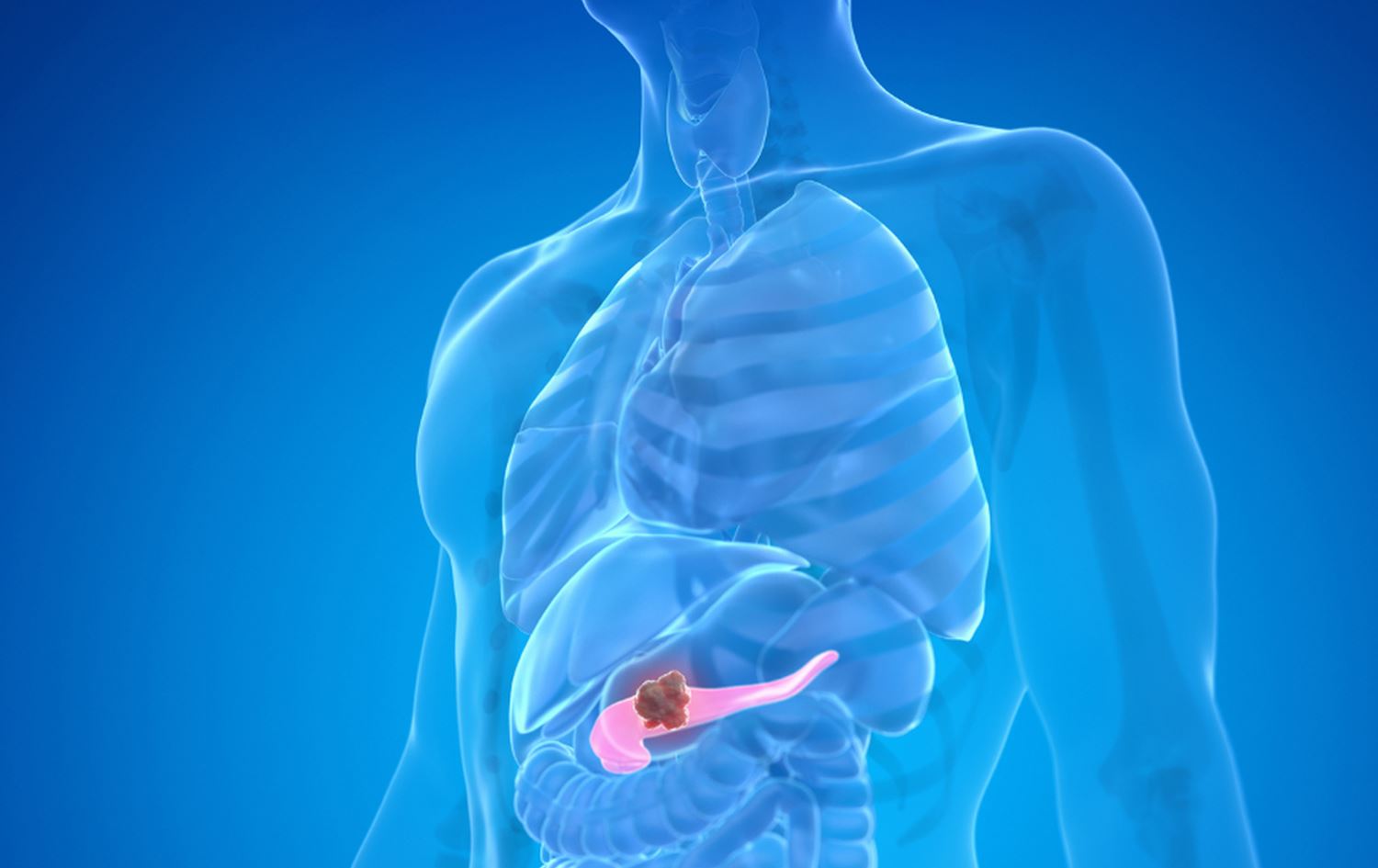 شێرپەنجەی پەنکریاس لە مرۆڤ.