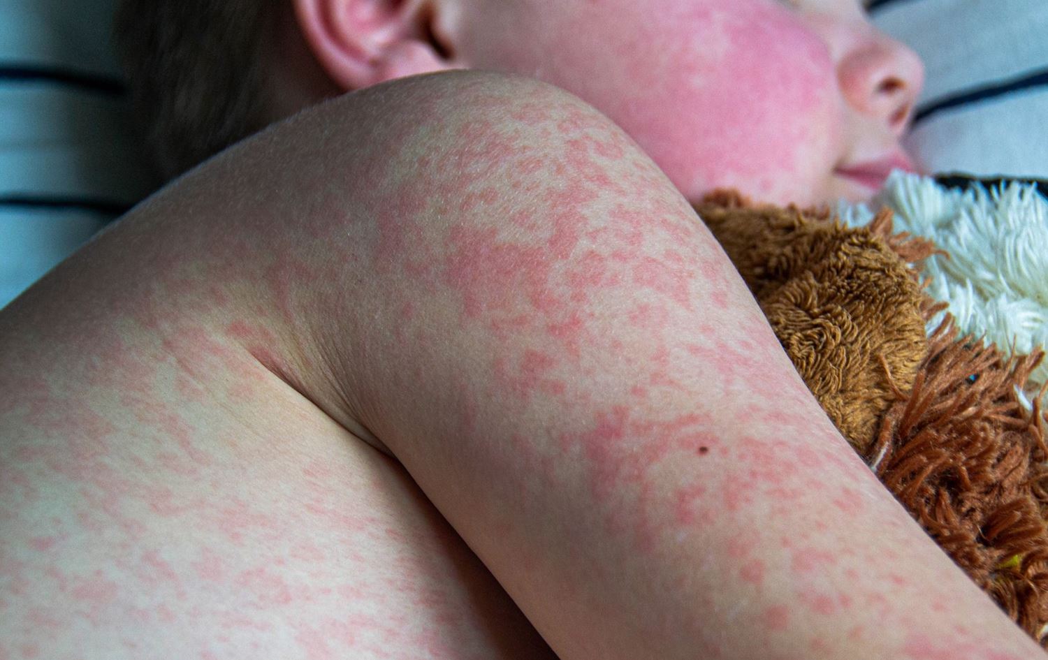 منداڵێكی تووشبووی سوورێژە.