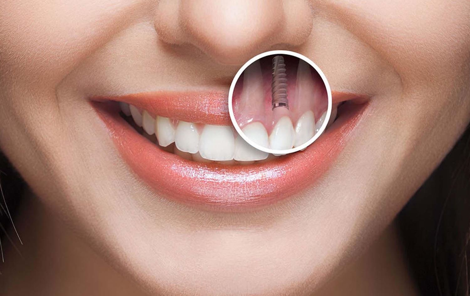 چاندنەوەی ددان.