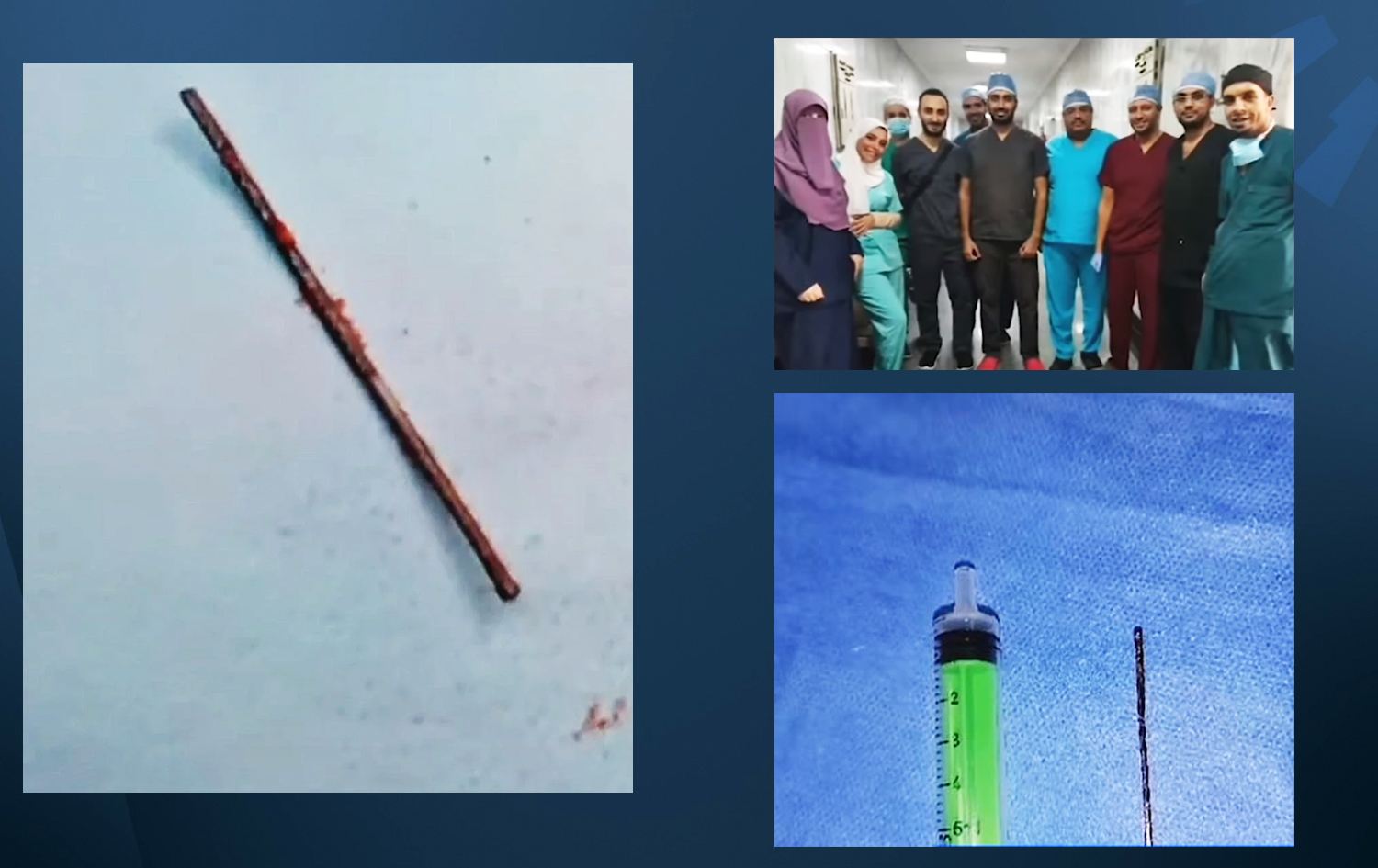 تیمی نەشتەرگەران و ئەو بزمارەی لە دڵی منداڵەکەدا چەقیبوو. وێنە: Extra News 