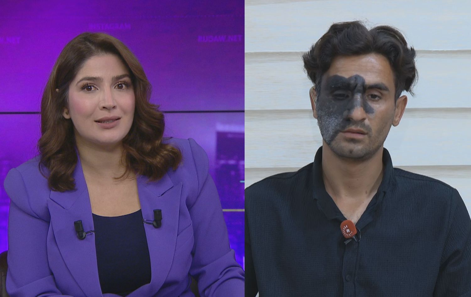 گەنجێکی 25 ساڵ: بەهۆی نیشانەی دەموچاومەوە ئاستەنگ بۆ پێکهێنانی ژیانی هاوژینیم دروستبووە